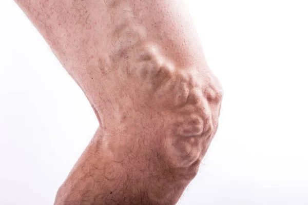Human leg with blocked veins — Stock Photo, Image