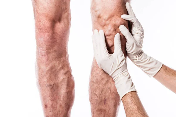 Lekarz bada nogi z zablokowanych żył — Zdjęcie stockowe