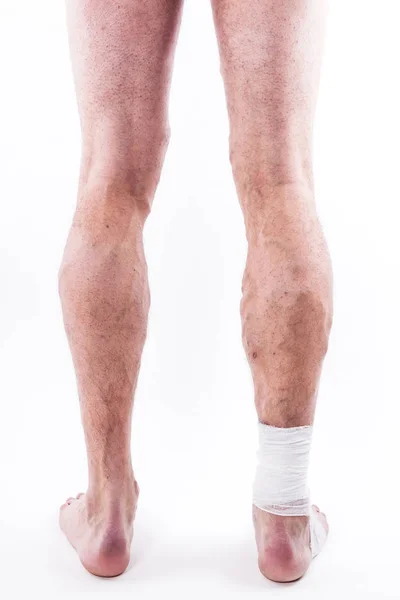Человеческие ноги с заблокированными венами — стоковое фото