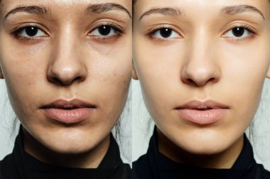 Önce ve sonra kozmetik işlemi.