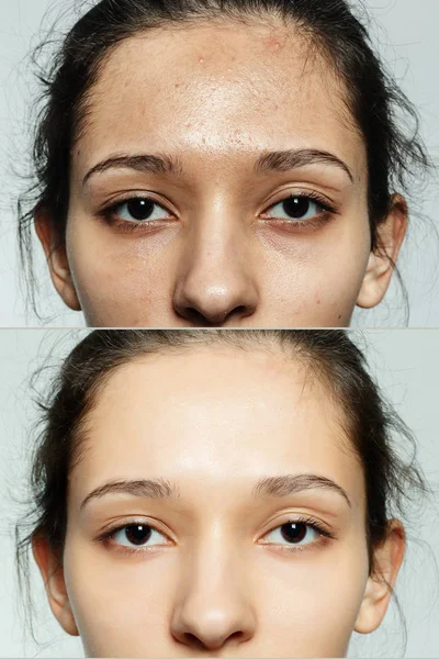 Before and after cosmetic operation. — Stock Photo, Image