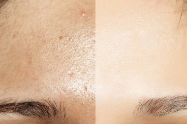 Önce ve sonra kozmetik işlemi.