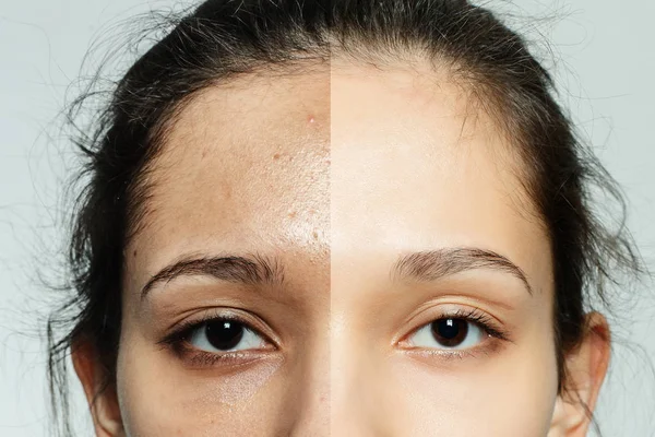 Before and after cosmetic operation. — Stock Photo, Image