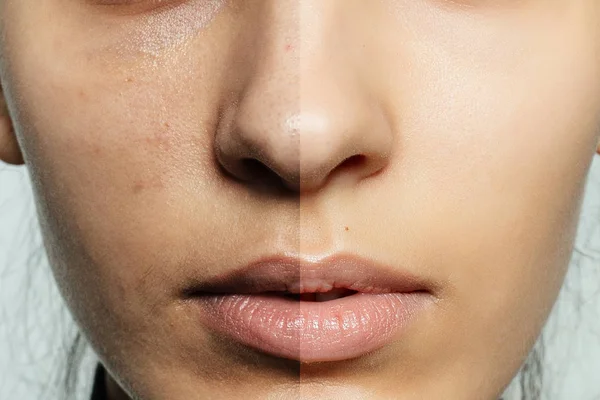 Before and after cosmetic operation. — Stock Photo, Image