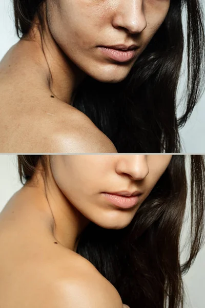 Before and after cosmetic operation. — Stock Photo, Image