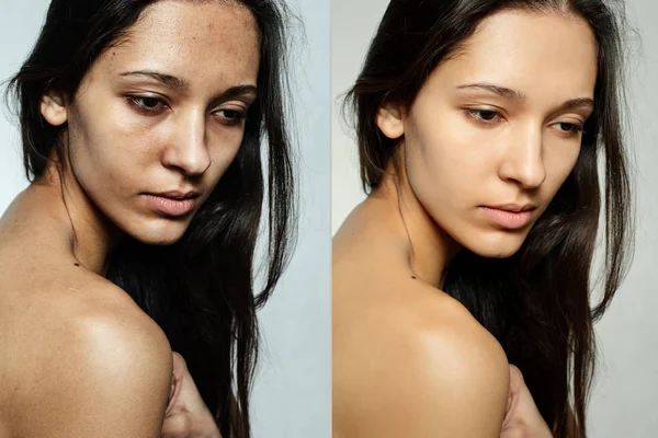 До и после косметической операции . — стоковое фото