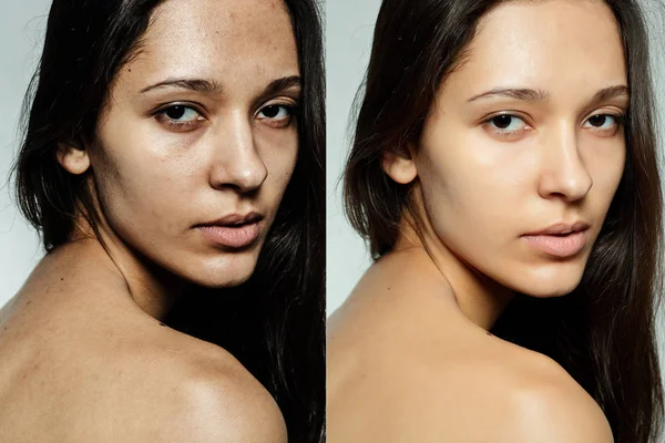 Przed i po operacji kosmetycznych. — Zdjęcie stockowe