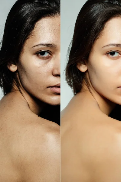 Antes y después de la operación cosmética . — Foto de Stock