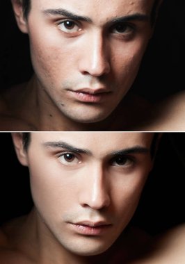 Before and after cosmetic operation. Young man portrait