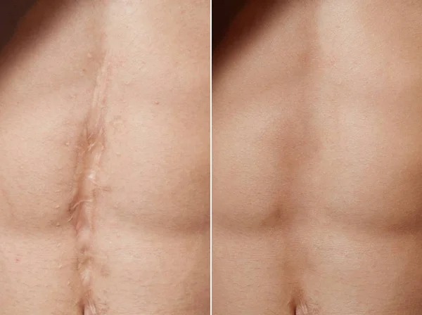 Remoção de cicatriz a laser antes e depois — Fotografia de Stock