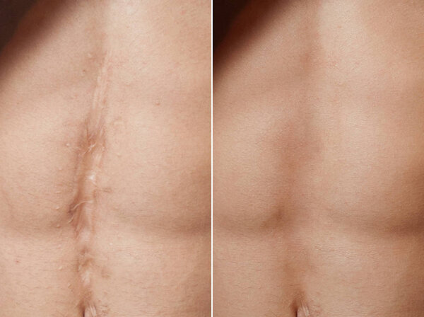 Laser scar removal before and after