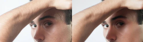 Antes e depois da operação cosmética. Retrato de jovem — Fotografia de Stock