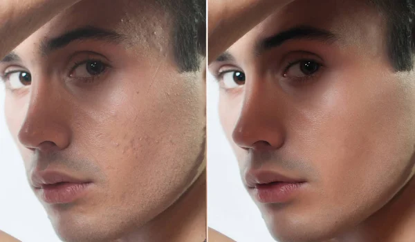 Przed i po operacji kosmetycznych. Portret młodzieńca — Zdjęcie stockowe