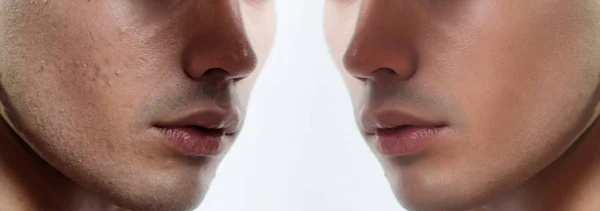 Before and after cosmetic operation. Young man portrait — Stock Photo, Image