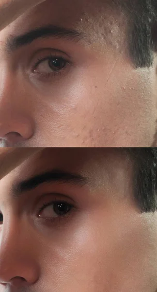Vor und nach kosmetischen Operationen. Porträt eines jungen Mannes — Stockfoto