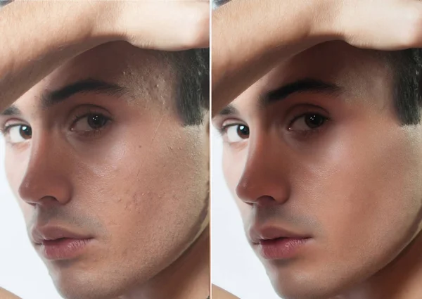 Antes y después de la operación cosmética. Retrato de hombre joven — Foto de Stock