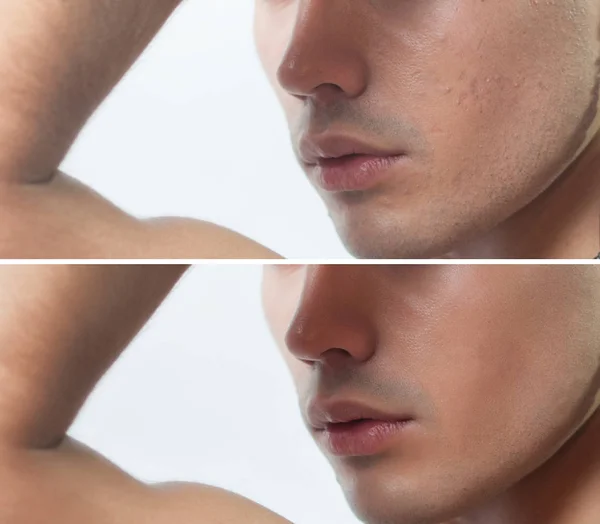 Antes y después de la operación cosmética. Retrato de hombre joven — Foto de Stock