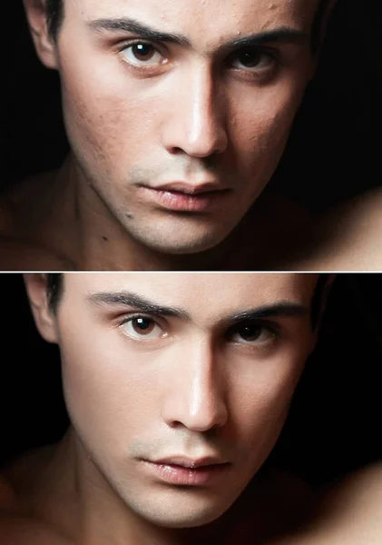 Πριν και μετά την επέμβαση αισθητικής χειρουργικής. Νεαρός άνδρας πορτρέτο — Φωτογραφία Αρχείου