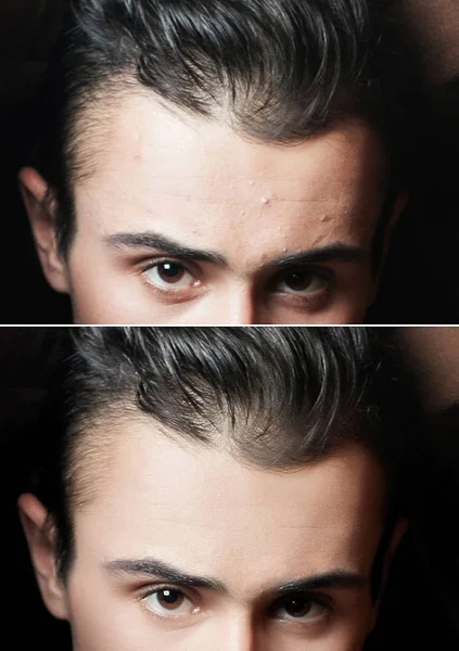 Antes y después de la operación cosmética. Retrato de hombre joven — Foto de Stock