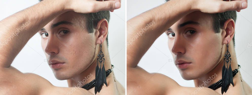 Before and after cosmetic operation. Young man portrait