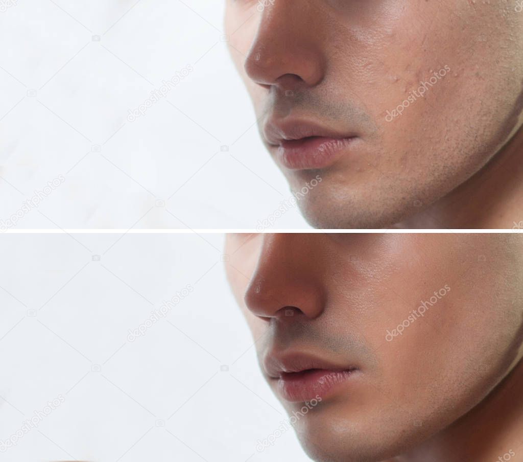 Before and after cosmetic operation. Young man portrait