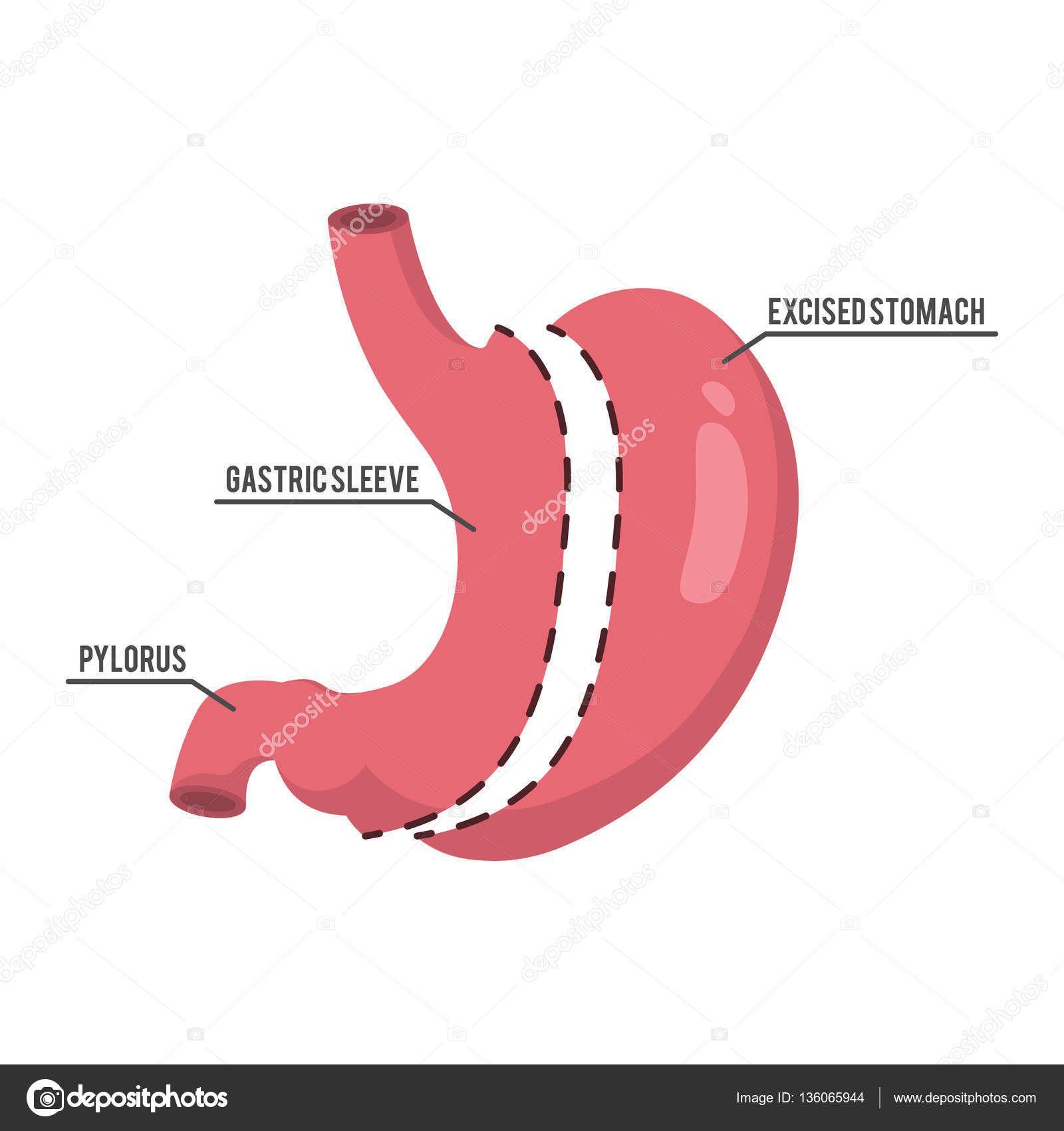 Vertical sleeve gastrectomy illustration design Stock Vector Image by