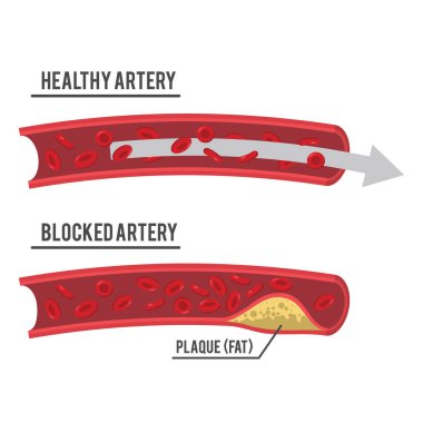 healthy artery and blocked artery clipart