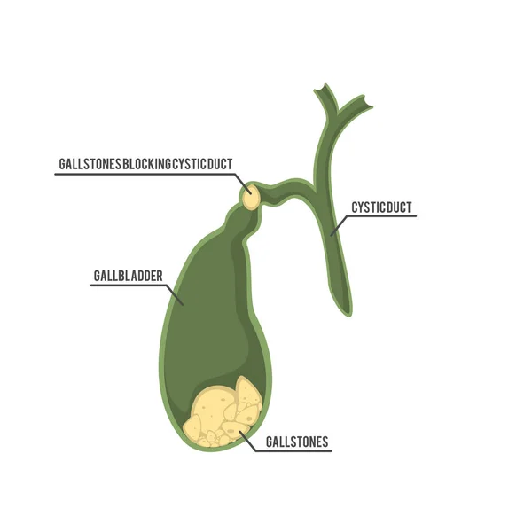 Inside human gallbladder with gallstones — Stock Vector