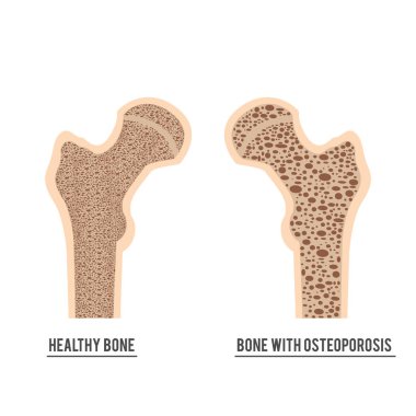 normal kemik ve kemik Osteoporoz ile