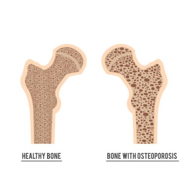 normal bone and bone with osteoporosis clipart