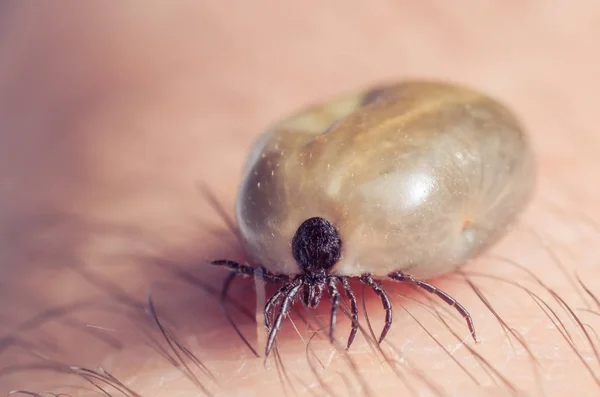 Tick filled with blood sitting on human skin — Stock Photo, Image