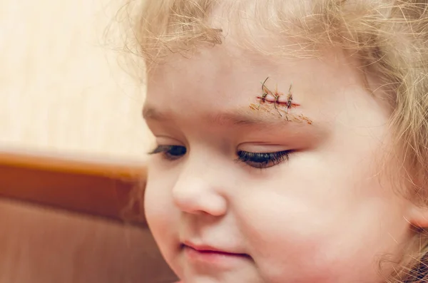 眉の上に傷のある少女深い傷が縫われた — ストック写真