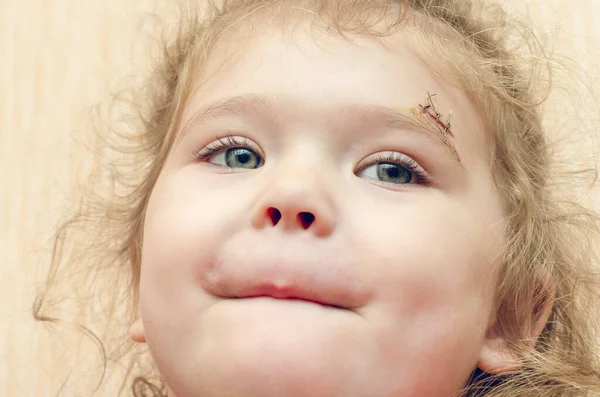 Kaşının üstünde yara izi olan küçük bir kız, dikilmiş derin bir yara. — Stok fotoğraf