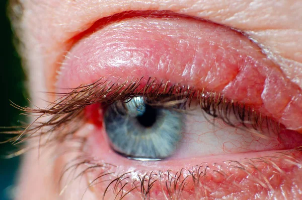 Раздражённый инфицированный красный глаз, ячменная инфекция глаза — стоковое фото