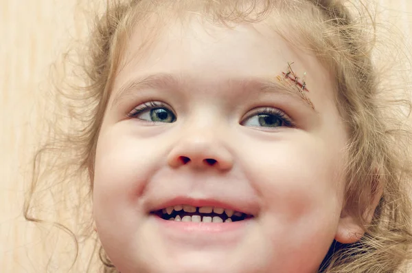 Uma menina com uma cicatriz acima da sobrancelha, uma ferida profunda costurada — Fotografia de Stock