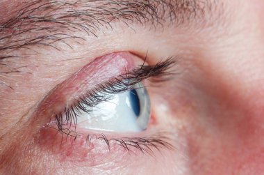 Yakından bir adamın göz kapağında Chalazion