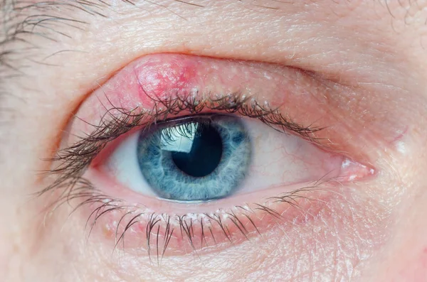 Chalazion op het ooglid van een man close-up — Stockfoto