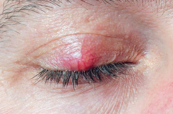 Chalazion op het ooglid van een man close-up — Stockfoto