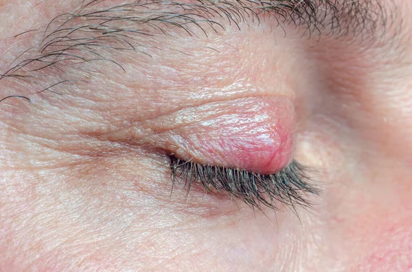 Chalazion Pálpebra Homem Close — Fotografia de Stock