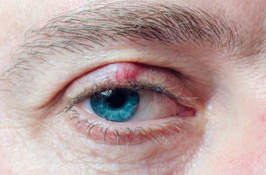 Chalazion on the eyelid of a man close-up. clipart