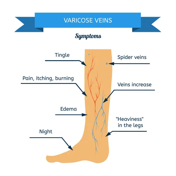 Síntomas de venas varicosas . — Vector de stock