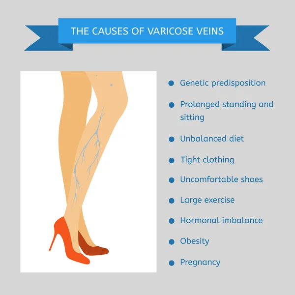 Las causas de las varices . — Vector de stock