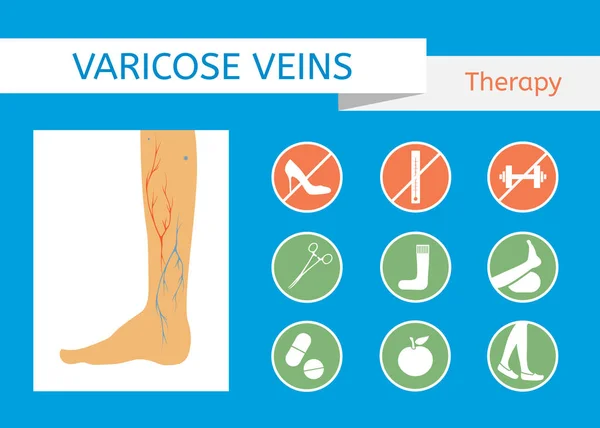 Tratamiento de venas varicosas . — Vector de stock