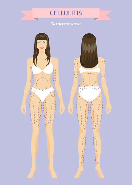 Hermosa joven. Áreas de desarrollo de la celulitis. Infografías — Vector de stock