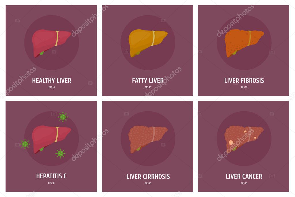 A set of healthy liver and its various diseases: hepatitis, cancer, obesity, cirrhosis. Vector flat illustration
