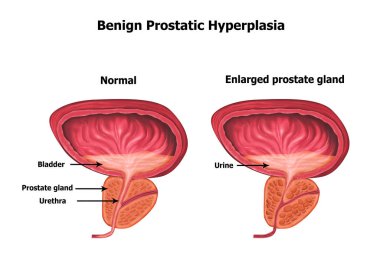 Illustration of human benign-prostatic-hyperplasia clipart