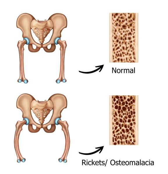 Illustrazione Rickets Osteopatici Umani — Foto Stock