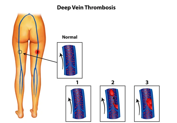 Illustration Der Menschlichen Tiefvenenthrombose — Stockfoto