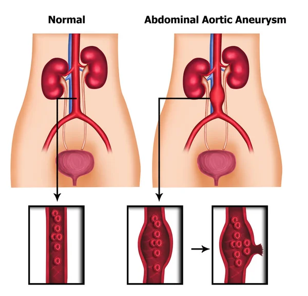 Ilustración Del Aneurisma Abdominal Aorético Humano —  Fotos de Stock