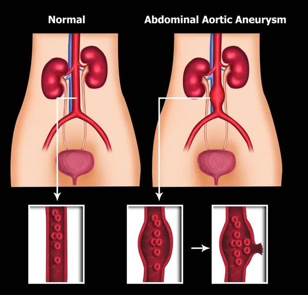 Ilustrace Lidského Abdominálního Aortálního Aneurysma — Stock fotografie